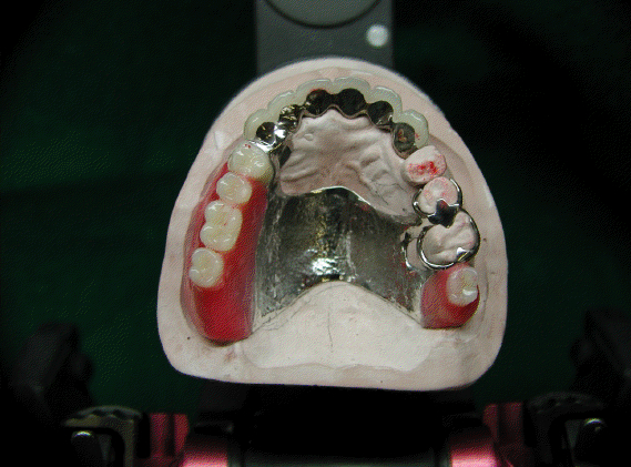 金属床義歯とメタルボンド・クラウン